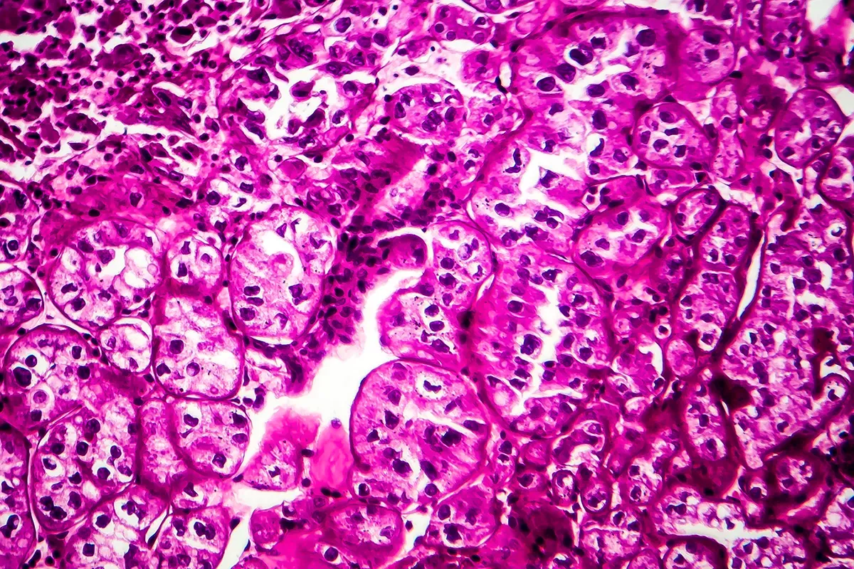 Tumeur du rein | Uropole 71 - Urologues à Chalon
