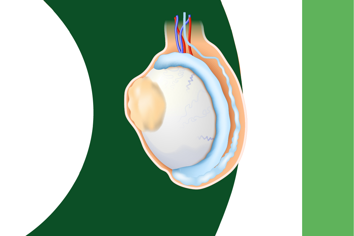 Kystes sébacés scrotaux | Uropole 71 - Urologues à Chalon