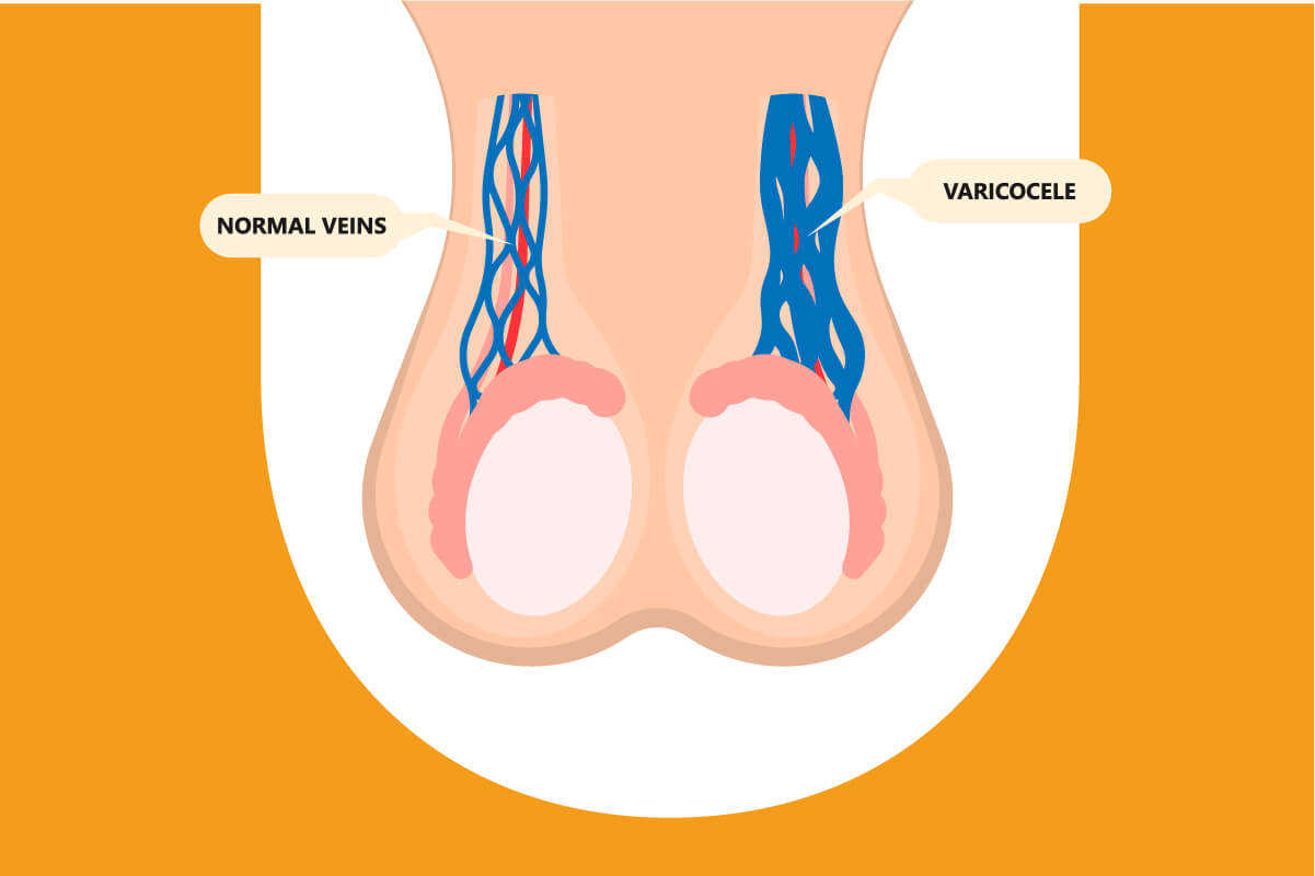 Varicocèle | Uropole 71 - Urologues à Chalon